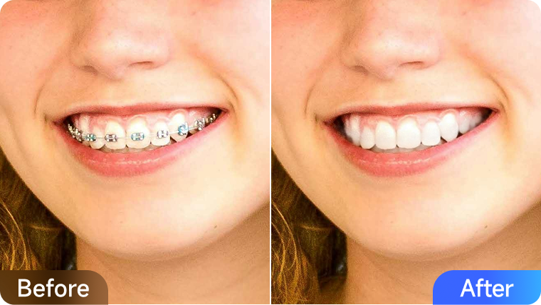 teethwhiten